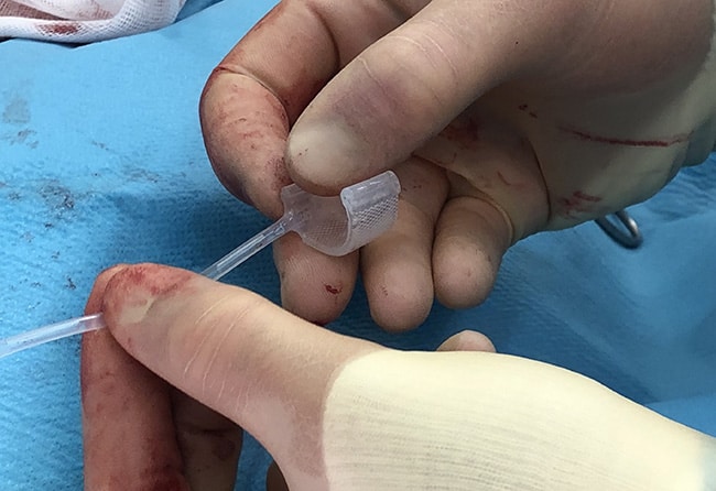 Artificial Urethral Sphincter