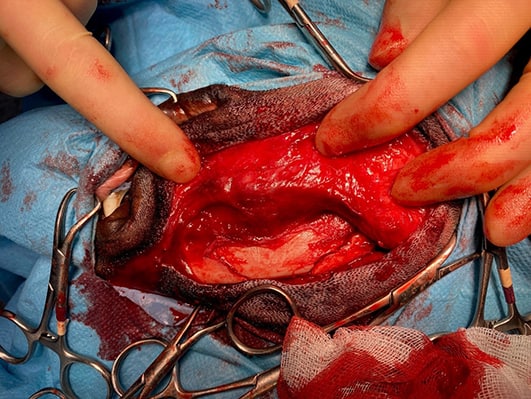 Fracture of Lenny’s mandible