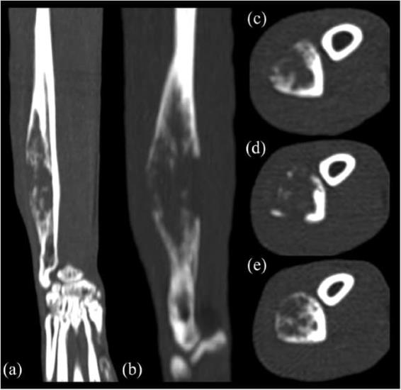 Sterile osteomyelitis in the ulnar diaphysis