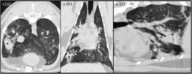 Sterile osteomyelitis