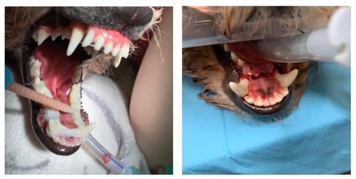 Repairing a bilateral fractures