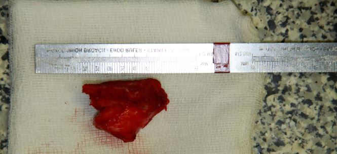 fragmentation of the retroarticular process