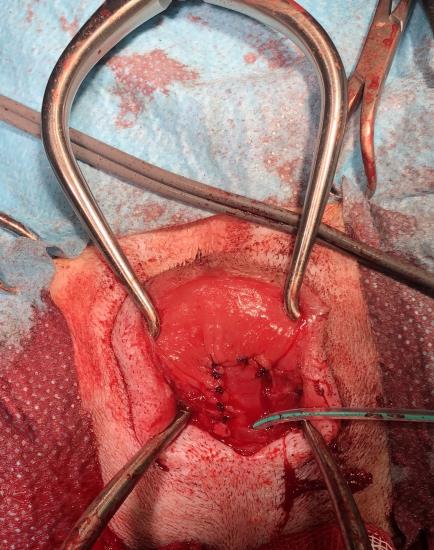 Closing of defect left after surgery