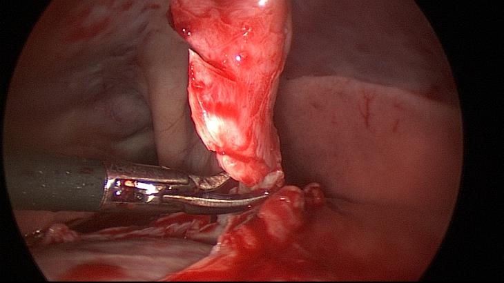 patch of pericardium resected