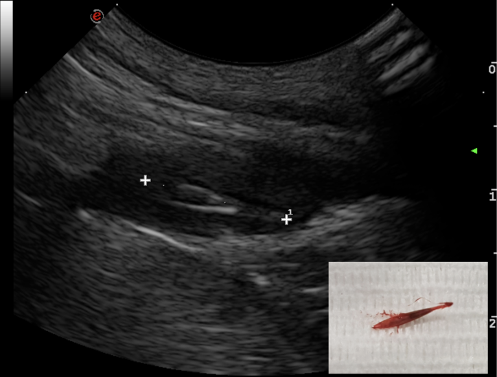 Referral ultrasound of dog with grass seed