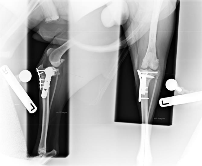 Combined excessive tibial plateal treatment