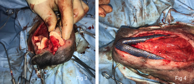 Titanium patient specific implant in jaw reconstruction