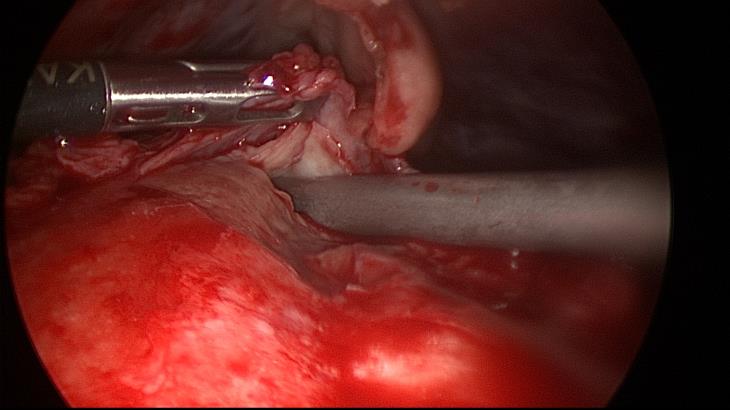 Thickened pericardium