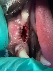 The tooth causing the cyst has been removed