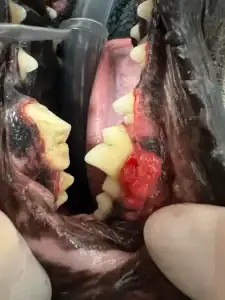 This image show an ulcerated growth adjacent to the lower first molar tooth