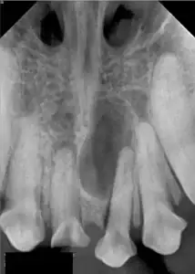 This is an X-ray of a lower jaw affected by a large cystic lesion