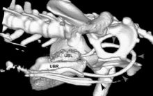 Volume rendered CT of left-sided retrograde urethrography